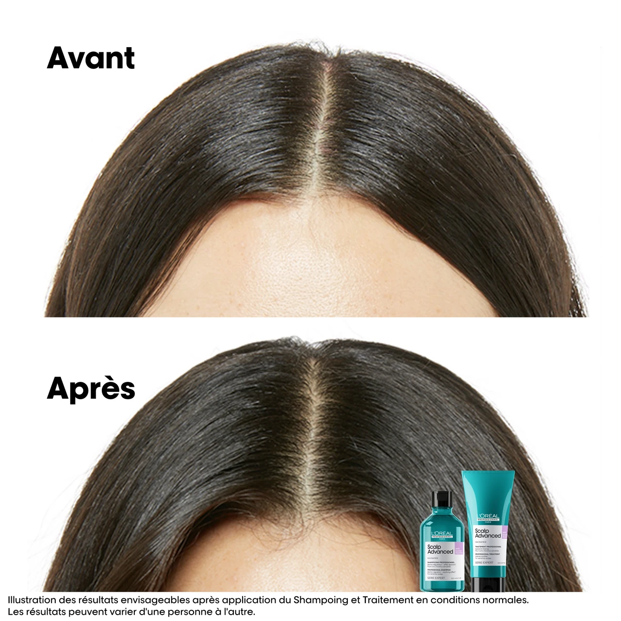 ShampooingAnti-Inconfort Scalp Advanced L'Oréal 1500ml 6 ShampooingAnti-Inconfort Scalp Advanced L'Oréal 1500ml – Image 4